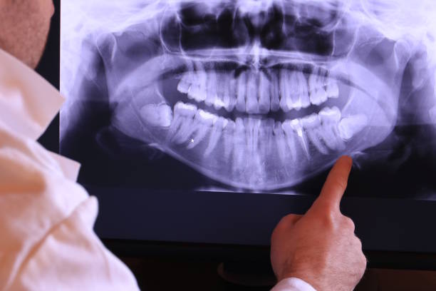 Best Emergency Wisdom Teeth Removal in Otterbe, IN